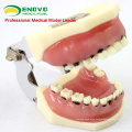SELL 12610 Severe Disease Jaw Model for Periodontal Surgery Training